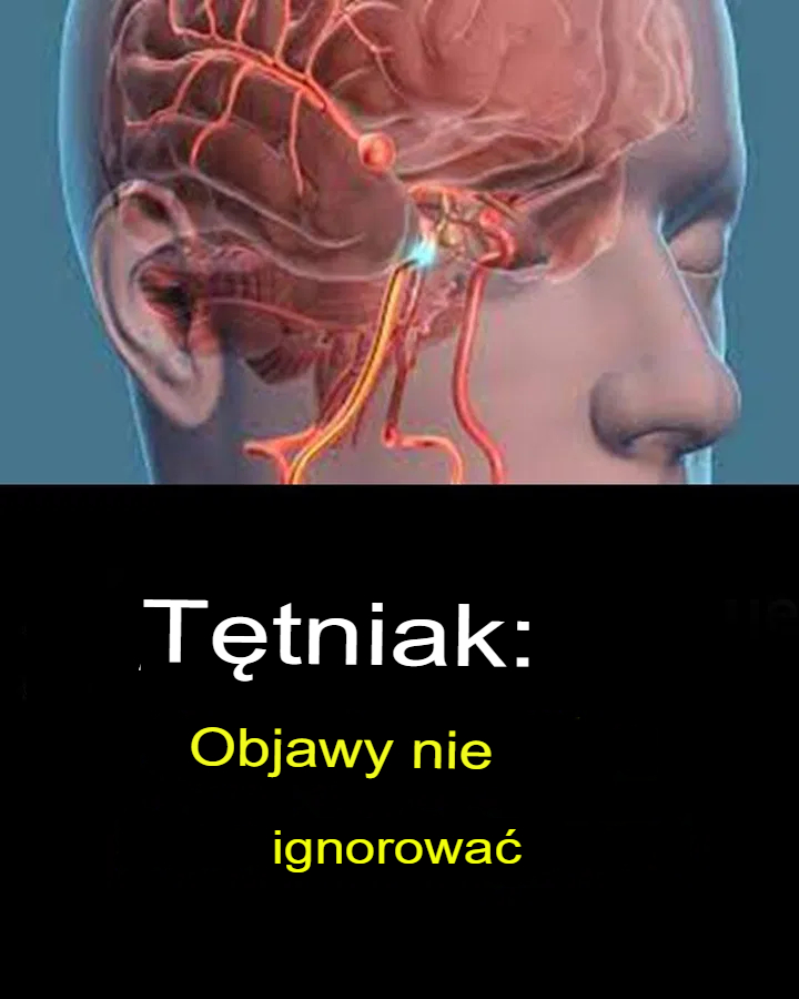 Tętniak mózgu – objawy, których nie wolno ignorować