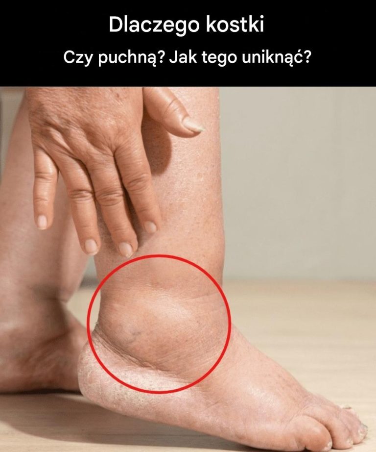 Opuchnięte nogi: jakie są objawy i sposoby rozwiązania problemu?