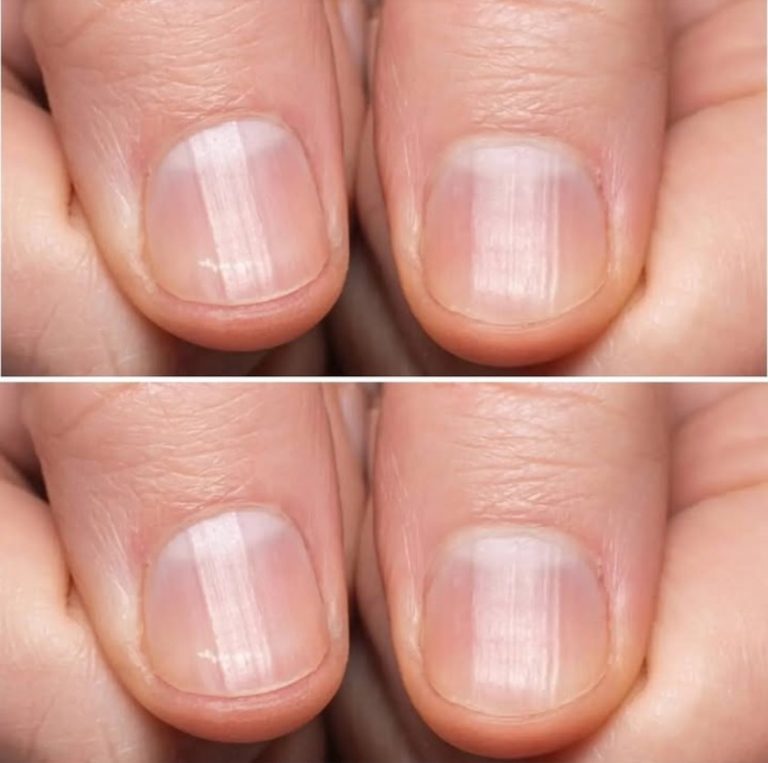 Pofałdowane, poplamione: co nasze paznokcie mówią o naszym zdrowiu