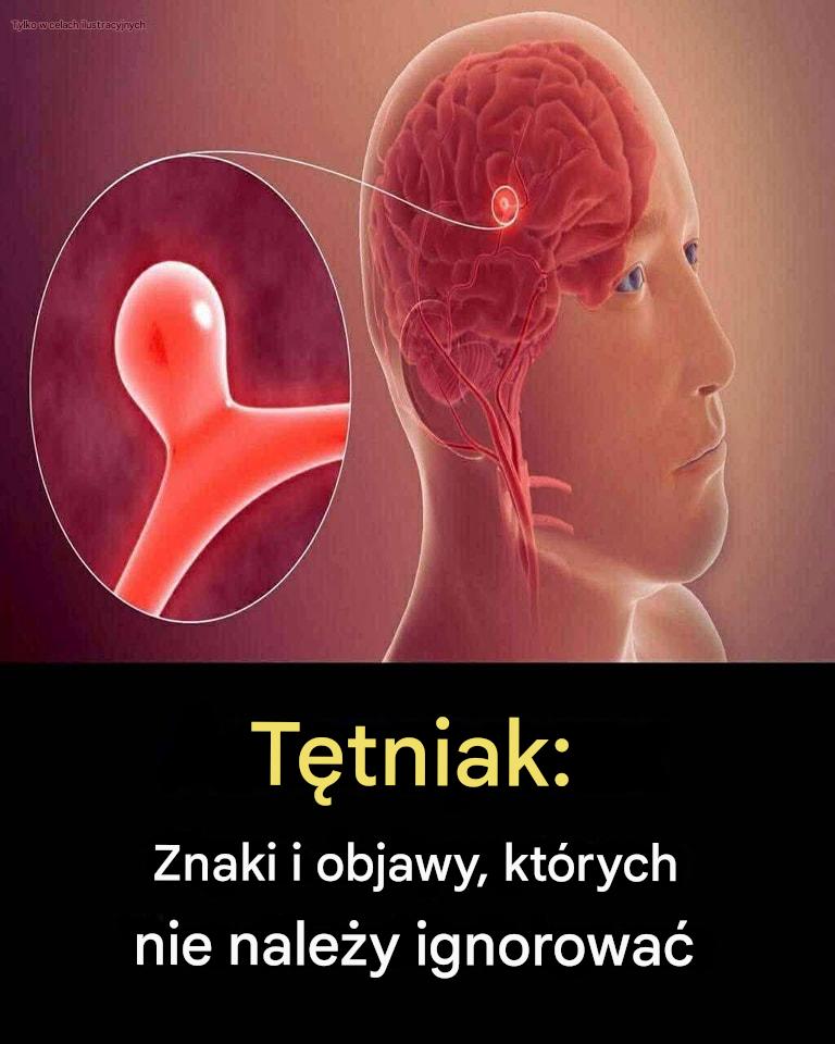 12 oznak, które mogą wskazywać na tętniaka mózgu — nie ignoruj ​​ich