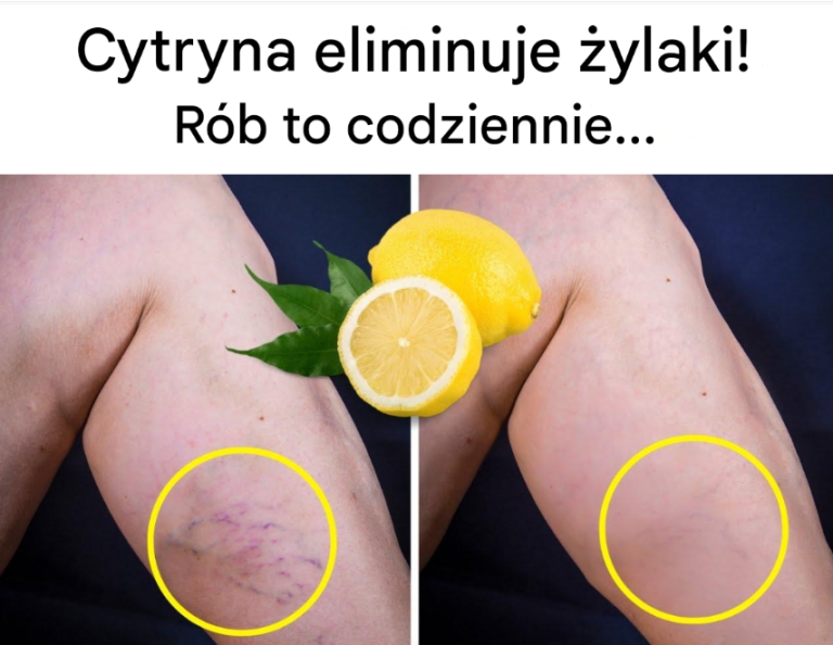 Cytryna eliminuje żylaki! Stosuj ją codziennie…