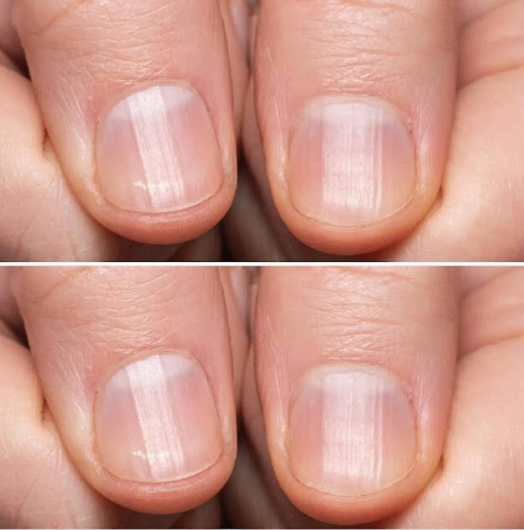 Pasiaste paznokcie mogą oznaczać, że Twoje ciało jest…