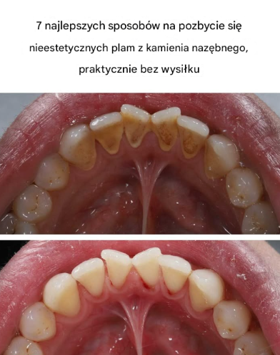 7 najlepszych sposobów na pozbycie się nieestetycznych plam z kamienia nazębnego niemal bez wysiłku