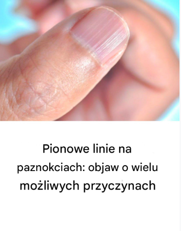 Pionowe linie na paznokciach: objaw o wielu możliwych przyczynach