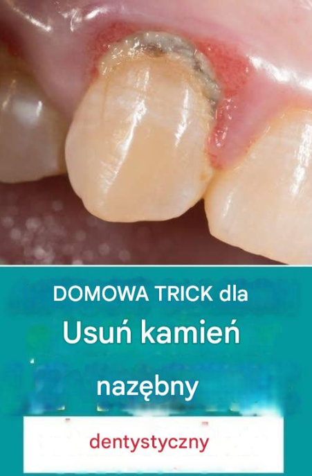 Domowy sposób na samodzielne usuwanie kamienia nazębnego