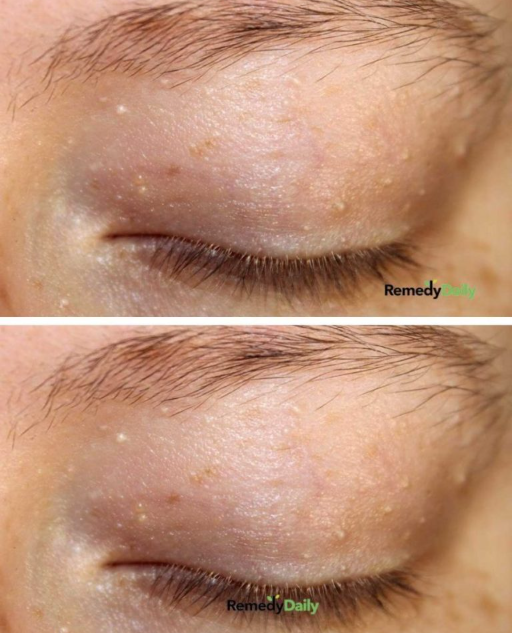 Mam mnóstwo białych grudek wokół oczu. Nie wyglądają jak pryszcze, więc nie wiem, czy powinnam je wyciskać. Co mogę zrobić?