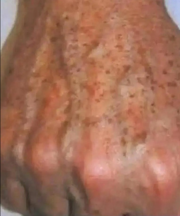 Czy wiesz, że jeśli na Twoich DŁONIACH pojawiają się PLAMY, to znak, że cierpisz na jakąś chorobę!